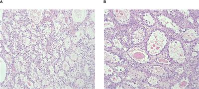 Clinical and pathological characteristics of cervical clear cell carcinoma in patients not exposed to diethylstilbestrol: a comprehensive analysis of 49 cases